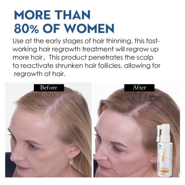 Anti Hair Loss Products Hair Growth Spray Essential Oil Liquid for Men Women Hair Growth Essence Serum Hair Care Repair Growing
